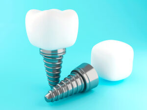 implantes dentários