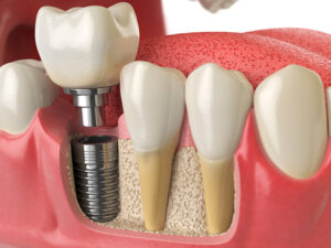 implantes dentários