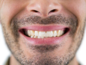 Lentes de contato dental