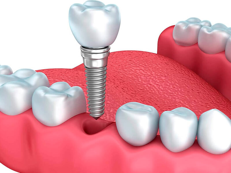 Próteses dentárias